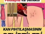 Bu Belirtiler Varsa Kanınızda Pıhtılaşma Var Demektir