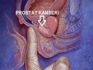 Türkiye'de erkeklerde en sık görülen ikinci kanser türü olan prostat kanserinde tarama tetkikleriyle erken tanı mümkün. Türkiye'de erkeklerde en sık görülen ikinci kanser türü olan prostat kanseri vatandaşların merak ettiği konu olarak dikkat çekiyor. Peki, prostat kanserinin belirtileri neler? Prostat kanseri nedir?