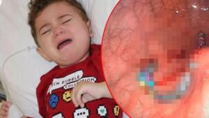 PAMUKKALE, DENİZLİ (AA) - Denizli'deki Pamukkale Üniversitesi Hastanesinde 19 aylık çocuğun midesinden, piyasada oyuncak olarak satılan boncuk biçimdeki mıknatıslardan 17 adet çıkarıldı. Pamukkale ilçesinde yaşayan Özdemir ailesinin 19 aylık çocukları Murat, geçen hafta apansız rahatsızlanınca özel bir hastaneye götürüldü. Akciğer enfeksiyonu şikayeti üzerine çekilen röntgende, çocuğun midesinde yabancı cisim bulunduğu tespit edildi.