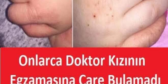 Onlarca Doktor Kızının Egzamasına Çare Bulamadı, Anne Çareyi Market Rafında Şans Eseri Buldu