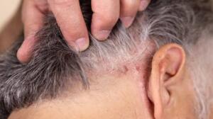 Saç derisinde kabuklanmanın en yaygın sebebi strestir. Stres sonucu oluşan kabuklanma anında uzman bir dermatologa danışılarak tedavi sürecine girilmelidir. Kuruyan saç derisi nasıl nemlendirilir? Saç gurusu Serkan Bozkurt cevaplıyor.