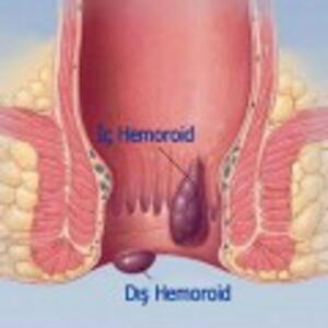 Hemoroid (Basur) sorunu yaşayanalar ayrıca şunlara dikkat etmelidir:
