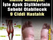 ŞİŞEN AYAKLARINIZI HAFİFE ALMAYIN. İŞTE AYAK ŞİŞLİKLERİNİN SEBEBİ OLABİLECEK 9 CİDDİ HASTALIK