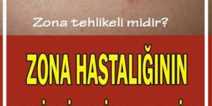Zona hastalığı nedir? Belirtileri ve tedavi yöntemleri nelerdir?