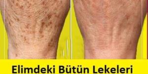 Ciltteki Kahverengi Lekeler Neden Oluşur? Nasıl Geçer?