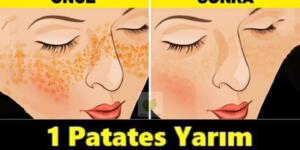 Cildinizin kusursuz görünmesini sağlamak ve lekelerden kurtulmak istiyorsanız