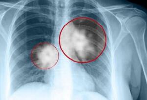 NEFES DARLIĞI Nefes darlığı ve hırıltılı soluma gibi solunumsal belirtiler akciğer kanserinin tüm evrelerinde ortaya çıkabiliyor. Sinsi gelişen bu hastalıkta önemli bir gösterge olan nefes darlığı, buna karşın ne yazık ki gerektiği şekilde önemsenmiyor. Ancak hekime görünmek gerekiyor.