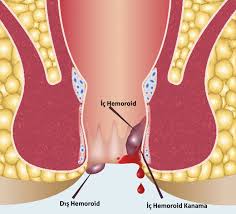 İç hemoroidler benzer şekilde şişip sarkabilir. Bu sarkma çeşitli seviyelerde olabilir. Hafif şişme 1inci derece, dışkılama sırasında sarkma 2inci derece; dışkılama sonrası geri girmeyen 3. derece ve hep dışarda kanamalı yer alması 4üncü derece olarak sınıflandırılır.