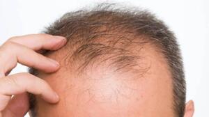 Kabak Çekirdeği Yağı Kabak çekirdeği yağı, testosteronun aktif dihidrotestosterona (DHT) dönüşümünü önleyen etkilere sahiptir. Androgenetik alopesi hastası olan 76 kişiye 24 hafta boyunca günde 400 mg oral kabak çekirdeği yağı verilmiştir. Plaseboya kıyasla hastaların % 40’ında saç sayısında artış gözlenmiştir.