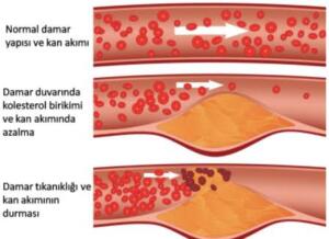 Total kolesterol (Toplam kolesterol) ise kanda bulunan bu iki kolesterol çeşidinin toplamı olarak ifade edilir. Kanda yüksek seviyede kolesterol bulunması, damarlarda sertleşmeye neden olmakla beraber kan damarlarında yağ birikintileri oluşmasına yol açabilir. Kolesterol plakları olarak adlandırılan bu birikintiler, zamanla büyüyerek damarlardan yeterli miktarda kan akmasını zorlaştırır. Bu da çeşitli sağlık problemlerine önayak olur. 