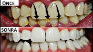 Diş tartarının diğer adı diş taşıdır. Dişlerde gıda kalıntısı birikmesi, bakteriler, genetik, diş ipi kullanmama, diş fırçalama alışkanlığı edinmeme gibi nedenlerden dolayı dişlerde zamanla tartar ve plak oluşumu gerçekleşir. İşte diş tartarı, diş taşını temizlemek için doğal çözümler...