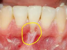 Diş eti çekilmesine çözüm mü arıyorsunuz? Diş eti çekilmesi yaşanmaması için alınması gereken tedbirler ve diş eti çekilmesinin tedavisi için bitkisel reçeteler bu yazıda. Ağız hijyenine dikkat edilmemesi, çeşitli hastalıklar diş ve diş eti hastalıklarına neden olur. Bu hastalıkların en başında ise diş eti çekilmesi gelir. Ağız içindeki bakterilerin zamanla çoğalması diş etinde erimelere ve çekilmelere neden olur. Diş atrofisi de denilen diş eti çekilmesi genellikle ihmal edilen ağız bakımı nedeniyle oluşur. Önlem alındığında kolayca çözülen bir durum olan diş eti çekilmesi tedavi geciktirildikçe uzun ve zorlu bir tedavi sürecine ihtiyaç duyar.