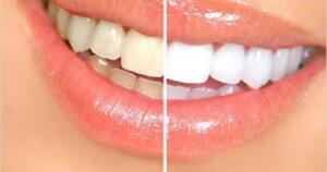 Düzenli olarak dişlerimizi fırçalasak ve kendimizce gerekli özeni göstersek de kimi zaman dişlerimizin sarardığına tanık oluruz. Bu yüzden dişlerimizi beyazlatmak için farklı yöntemler ve ekstra işlemler uygulamamız gerekebilir.